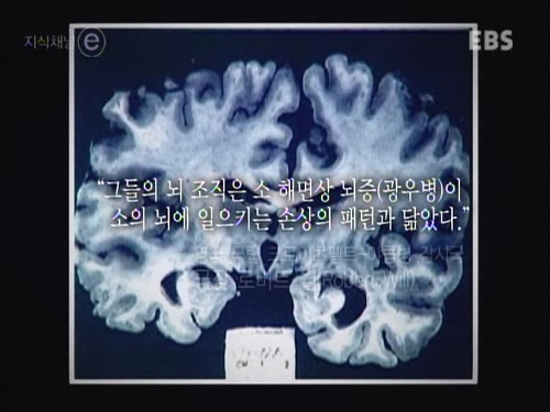 구멍난 뇌.jpg